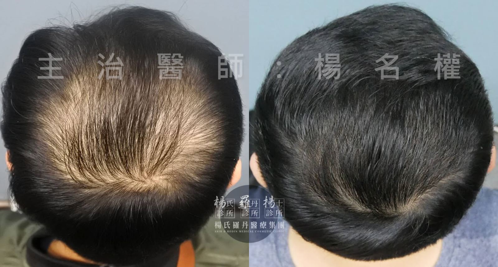 禿頭 掉髮 六合一三階段雄性禿治療 植髮 生髮